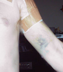 Photo of the inside of Hughie's left arm showing the blueberry muffin bruise on his bicep